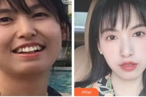 樂山口腔醫(yī)院魏寧整形價格表附金屬托槽矯正案例展示