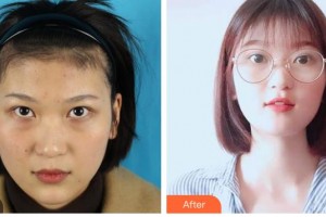 樂山愛爾眼科醫(yī)院張繼萍整形價格表附內(nèi)切祛眼袋案例展示