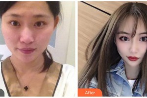 樂山愛爾眼科醫(yī)院宋德智整形價格表附眼部綜合案例展示