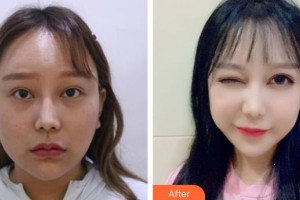 樂山愛爾眼科醫(yī)院帥彤整形價格表附眼部綜合案例展示