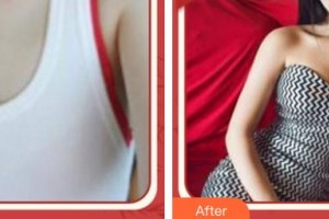 南充醫(yī)美整形外科診所劉乃軍整形價格表附自體脂肪隆胸案例展示