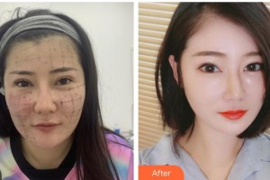 南充新韻悅美醫(yī)療美容門診部杜娟杜娟整形價格表附熱瑪吉案例展示