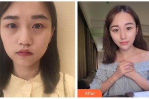 南充中心醫(yī)院整形美容外科李凌云整形價格表附熱瑪吉案例展示