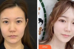 南充中心醫(yī)院整形美容外科肖文明整形價(jià)格表附熱瑪吉案例展示