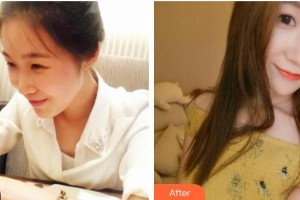 南充中心醫(yī)院整形美容外科張?zhí)m芳整形價(jià)格表附熱瑪吉案例展示