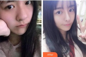 南充中心醫(yī)院整形美容外科蔣欣住院醫(yī)師整形價(jià)格表附熱瑪吉案例展示