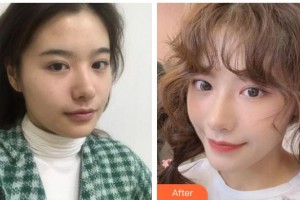 南充嘉陵江醫(yī)療美容診所彭海濤整形價(jià)格表附熱瑪吉案例展示