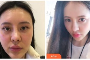 南充阿藍(lán)醫(yī)療美容門診部傅崇華整形價(jià)格表附埋線提升案例展示