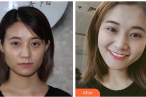 南充阿藍(lán)醫(yī)療美容門診部雷曉東整形價(jià)格表附埋線提升案例展示