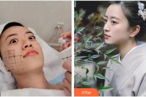 南充阿藍醫(yī)療美容門診部沙新力整形價格表附熱瑪吉案例展示