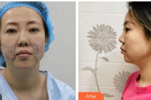 南充阿藍醫(yī)療美容門診部李仁華整形價格表附埋線提升案例展示