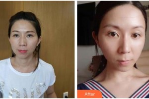 南充阿藍醫(yī)療美容門診部常明整形價格表附熱拉提案例展示