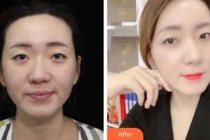 南充阿藍醫(yī)療美容門診部朱園杰整形價格表附熱拉提案例展示