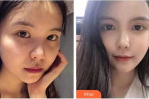 南充阿藍(lán)醫(yī)療美容門診部蘭秀整形價(jià)格表附熱瑪吉案例展示