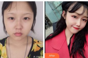 南充阿藍醫(yī)療美容門診部賀怡整形價格表附埋線提升案例展示