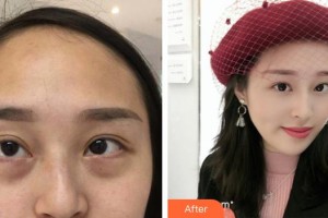 南充醫(yī)美整形外科診所袁學江整形價格表附內(nèi)切祛眼袋案例展示