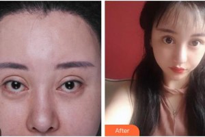 南充嬌美傾城醫(yī)學美容門診部劉娟整形價格表附眼部修復(fù)案例展示