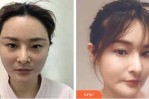 南充新韻悅美醫(yī)療美容門診部鄧志文整形價格表附埋線提升案例展示