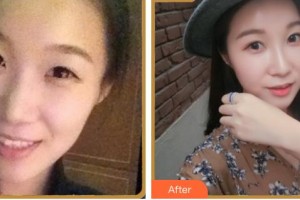 南充韓美整形美容門診部陳斌整形價格表附熱瑪吉案例展示