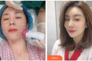 南充新韻悅美醫(yī)療美容門診部付崇華整形價格表附熱瑪吉案例展示