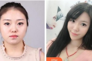 南充韓美整形美容門診部龔承安整形價格表附埋線提升案例展示