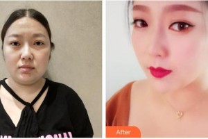 南充新韻悅美醫(yī)療美容門診部何秀整形價格表附埋線提升案例展示