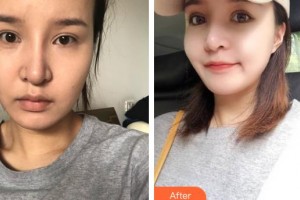 南充五星美容整形門診部劉漢儒整形價格表附埋線提升案例展示