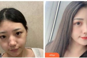 南充韓美整形美容門診部陳慶紅整形價(jià)格表附激光祛斑案例展示