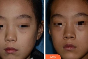 南充韓美整形美容門診部鄧麗華整形價(jià)格表附激光點(diǎn)痣案例展示