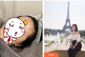 南充嬌美傾城醫(yī)學美容門診部余劍雄整形價格表附熱瑪吉案例展示