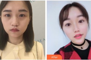 南充阿藍(lán)醫(yī)療美容門診部整形價(jià)格表附熱瑪吉案例展示