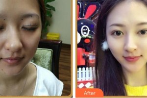 南充醫(yī)美爾美容整形診所劉明剛整形價(jià)格表附眼部綜合案例展示