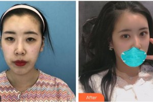 南充愛爾麥格眼科醫(yī)院冉海軍整形價(jià)格表附眼部綜合案例展示