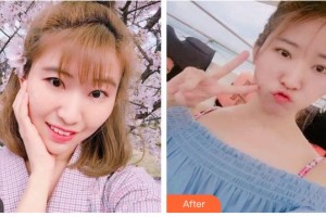 南充潤禾皮膚病?？漆t(yī)院趙成均住院醫(yī)師整形價(jià)格表附切開雙眼皮案例展示