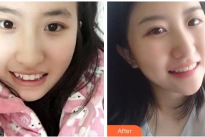 南充華醫(yī)口腔醫(yī)院楊建整形價(jià)格表附牙齒隱形矯正案例展示