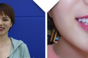 南充遠(yuǎn)大口腔門診部王云玲整形價(jià)格表附牙貼面案例展示