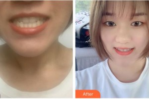 南充德美牙科診所歐陽霞整形價(jià)格表附金屬托槽矯正案例展示