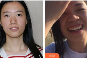 南充美佳口腔診所蘇懷風(fēng)整形價(jià)格表附牙齒隱形矯正案例展示