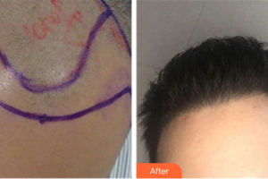 深圳麗格云發(fā)醫(yī)療美容診所石金鷺整形價(jià)格表附植發(fā)案例展示