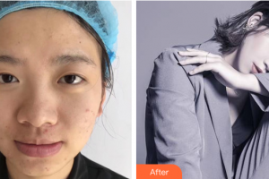 深圳陽(yáng)光整形美容醫(yī)院樸在久整形價(jià)格表附眼部手術(shù)案例展示