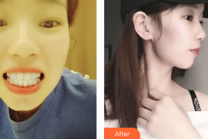 深圳童美口腔門診部唐海英整形價(jià)格表附牙齒矯正案例展示