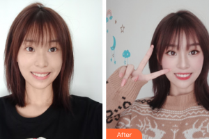 深圳寶城口腔醫(yī)院任斌整形價(jià)格表附超聲波洗牙案例展示