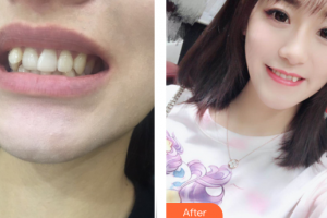 深圳諾德怡景口腔門診部鮑立峰整形價(jià)格表附牙齒矯正案例展示