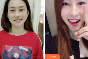 深圳南州口腔門診部李王勝整形價(jià)格表附牙齒隱形矯正案例展示