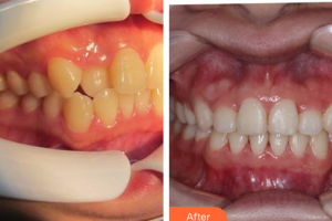 深圳浩?？谇婚T診部翟虎整形價(jià)格表附牙齒隱形矯正案例展示