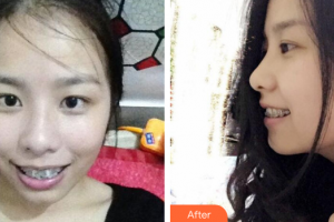 深圳美加美醫(yī)療美容門診部王曉紅整形價格表附金屬矯正案例展示