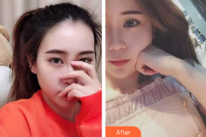 深圳諾德怡景口腔門診部文梁整形價格表附時代天使矯正案例展示