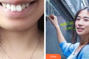 深圳羅湖區(qū)同步口腔門診部戴秀秀整形價格表附金屬矯正案例展示