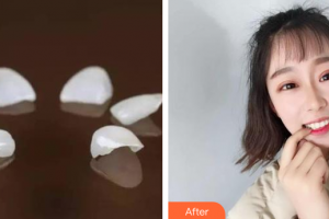 深圳口腔診所顏彬強整形價格表附瓷貼面案例展示