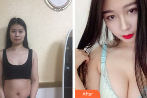 深圳劉博士醫(yī)療美容門診部劉學軍整形價格表附自體脂肪隆胸案例展示